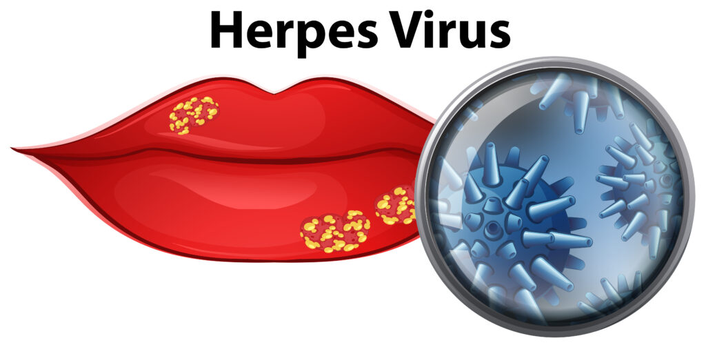 Herpes Virus Treatment in India